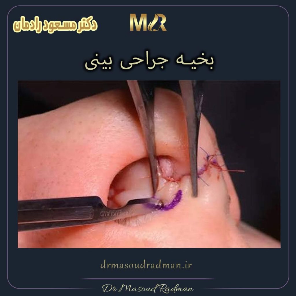 بخیه جراحی بینی