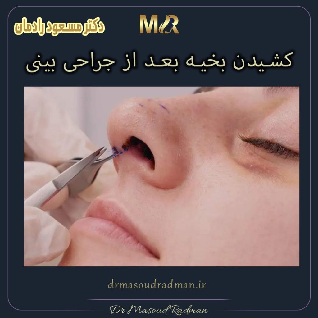 کشیدن بخیه بعد از جراحی بینی 