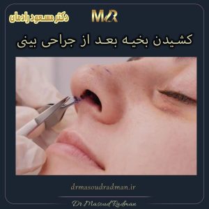 کشیدن بخیه بعد از جراحی بینی
