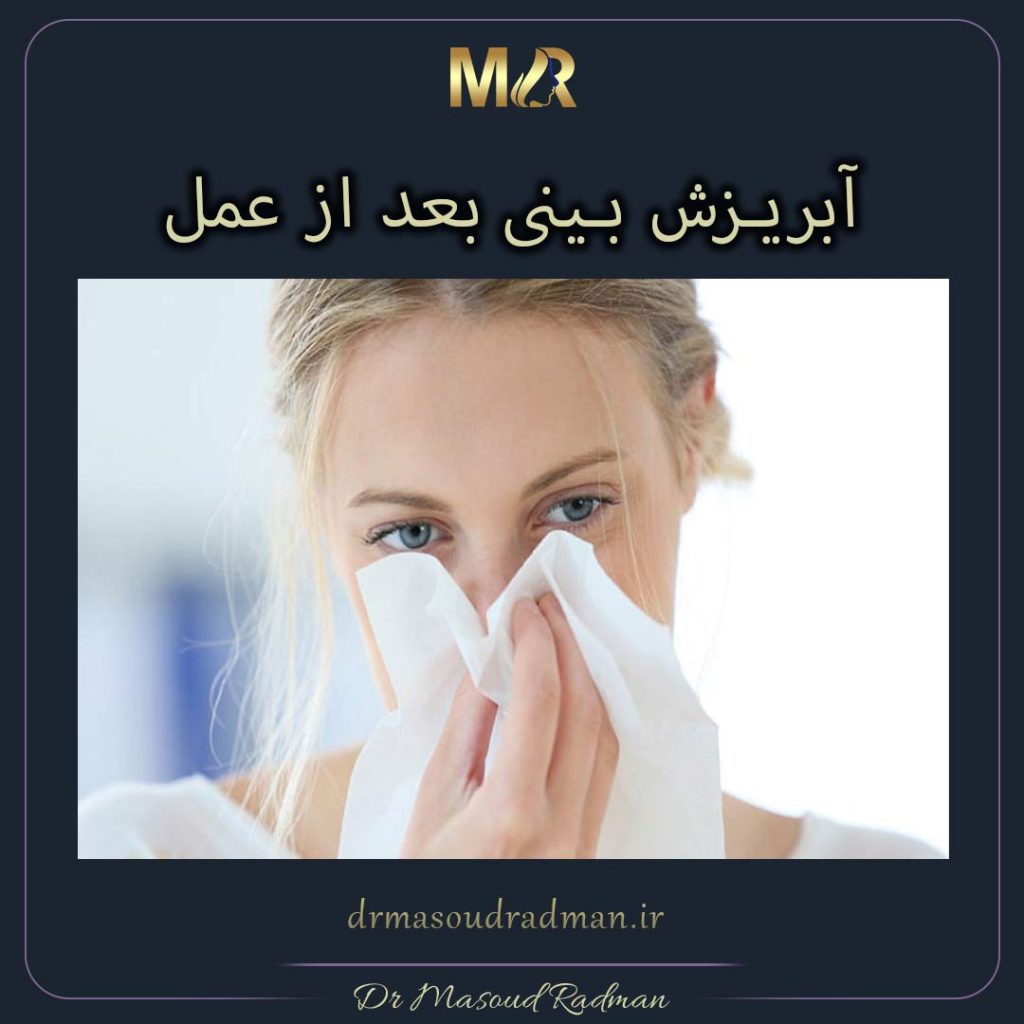 آبریزش بینی بعد از عمل