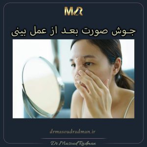 جوش صورت بعد از عمل بینی